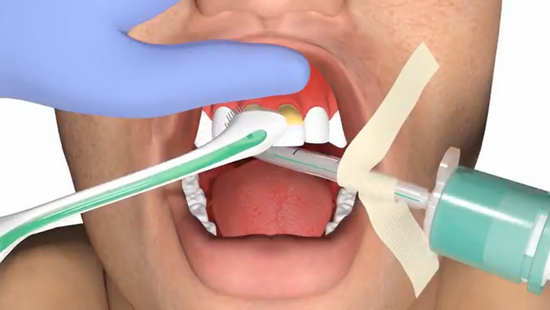 Performing the modified bass brushing technique for improved oral care